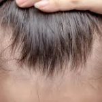 Hair Loss